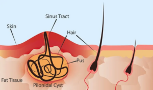 Diagram of Pilonidal Cysts