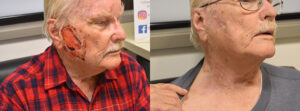 Post Cancer Reconstruction Before & After Skin Flap Surgery