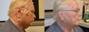 Post-Cancer Cervicofacial Flap Before & After