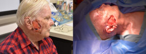 Post Cancer Patient In Need of Cervicofacial Flap Surgery