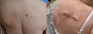 Initial Surgery Before & After - Melanoma on Back