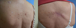 Melanoma Removal on Back Before & After