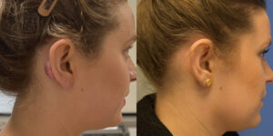 Scar Revision Patient 1a Before & After