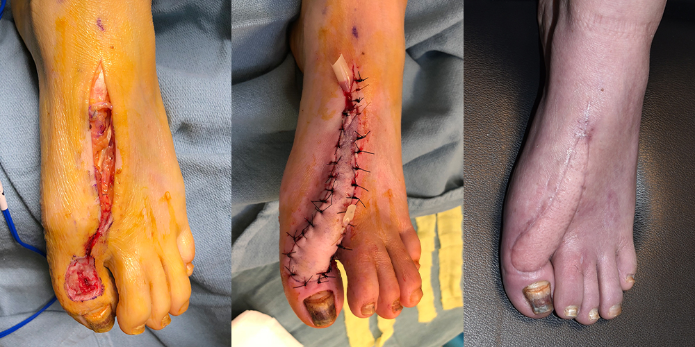 Traumatic Injury to the Foot Before, During & After Reconstruction