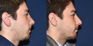 Nose Reconstruction Side View Before & After